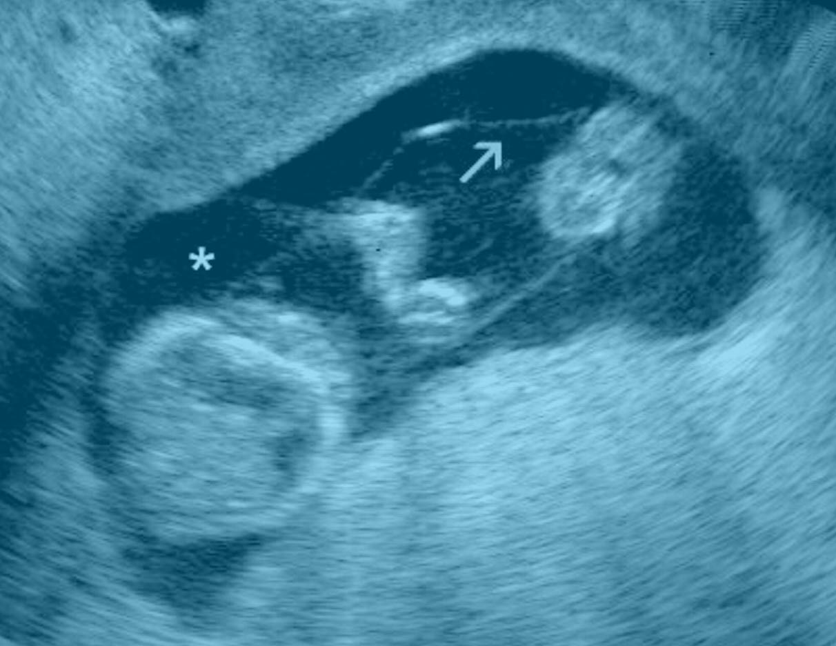 amniotic fluid embolism second pregnancy